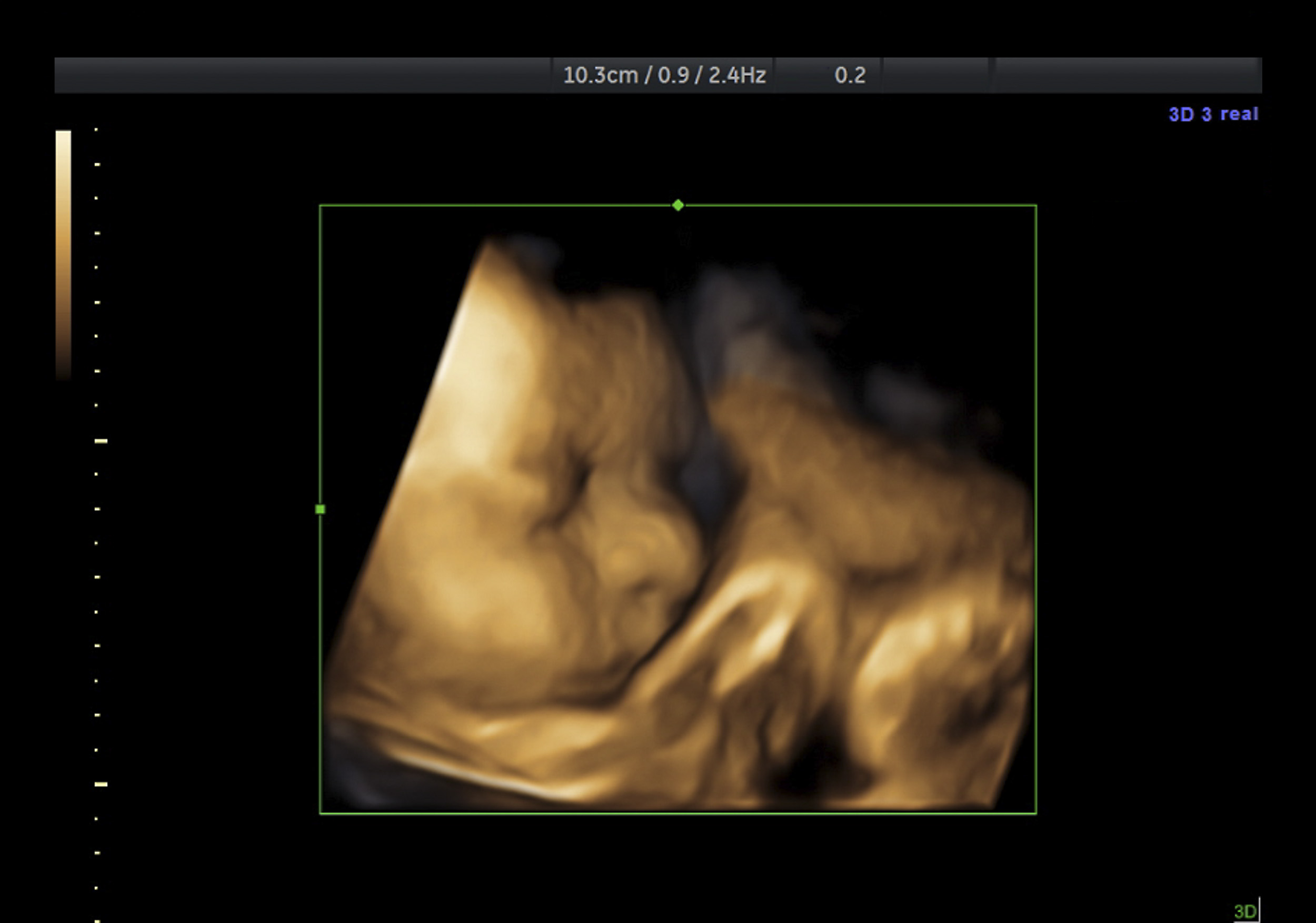 Care First Imaging | Baby 3d ultrasound